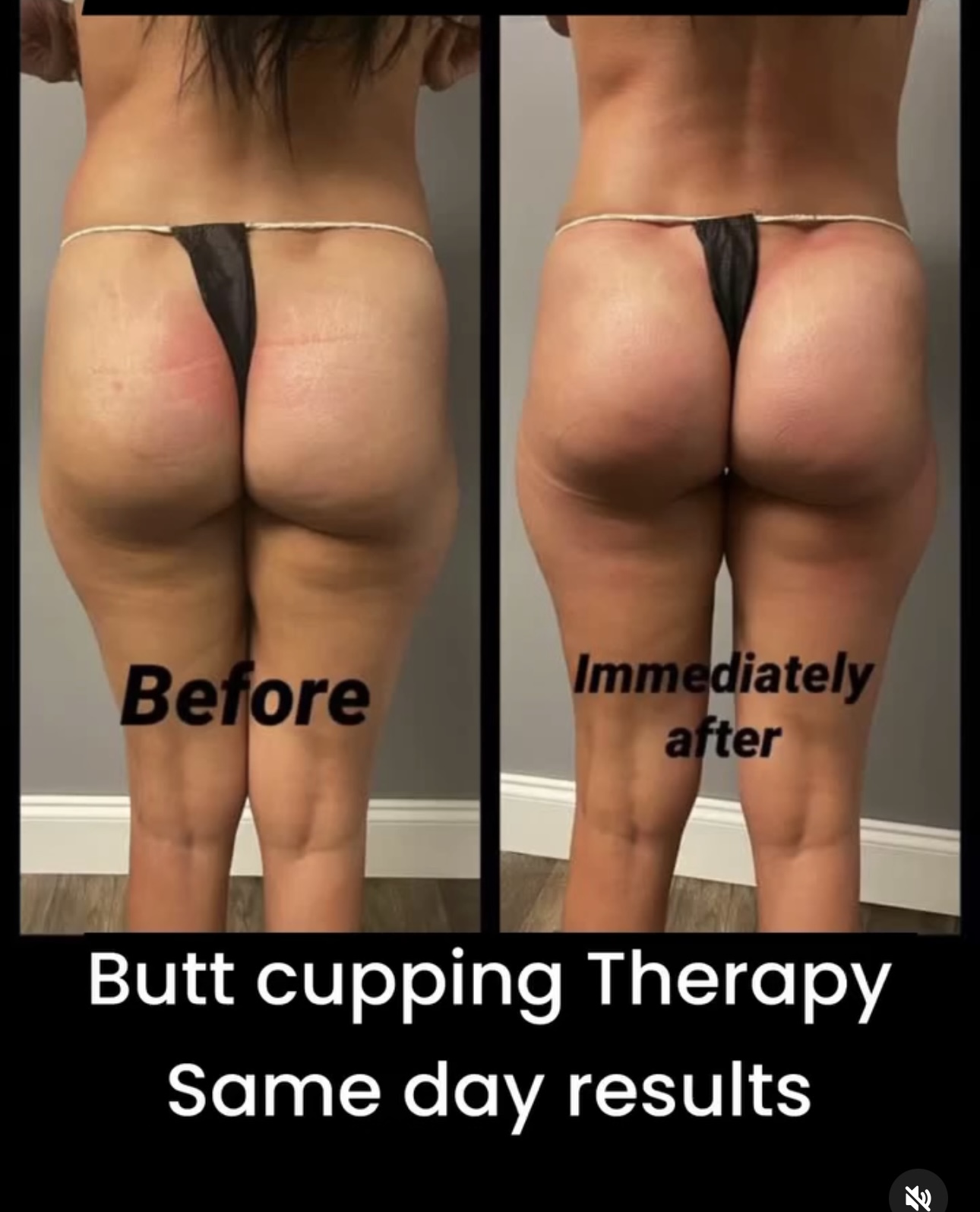 🍑 Butt Cupping Therapy transformation 1