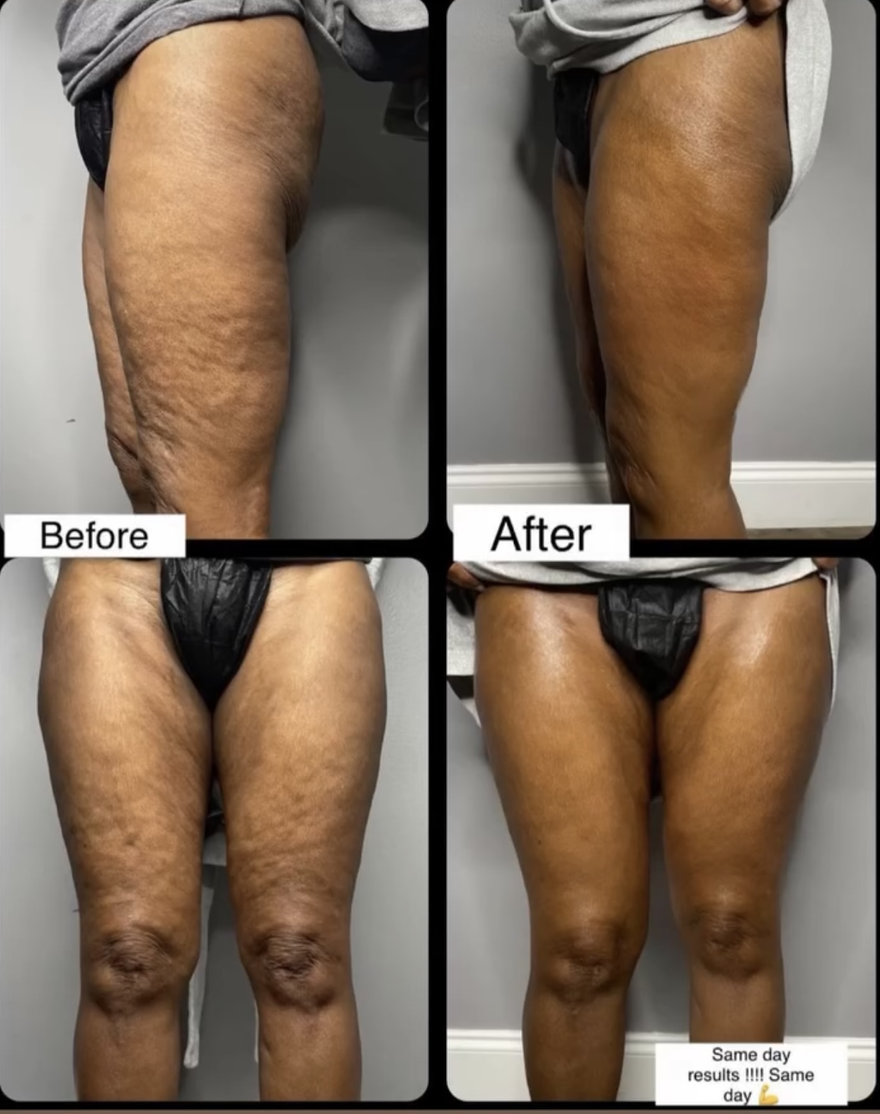 🦵 Skin Tightening transformation 1