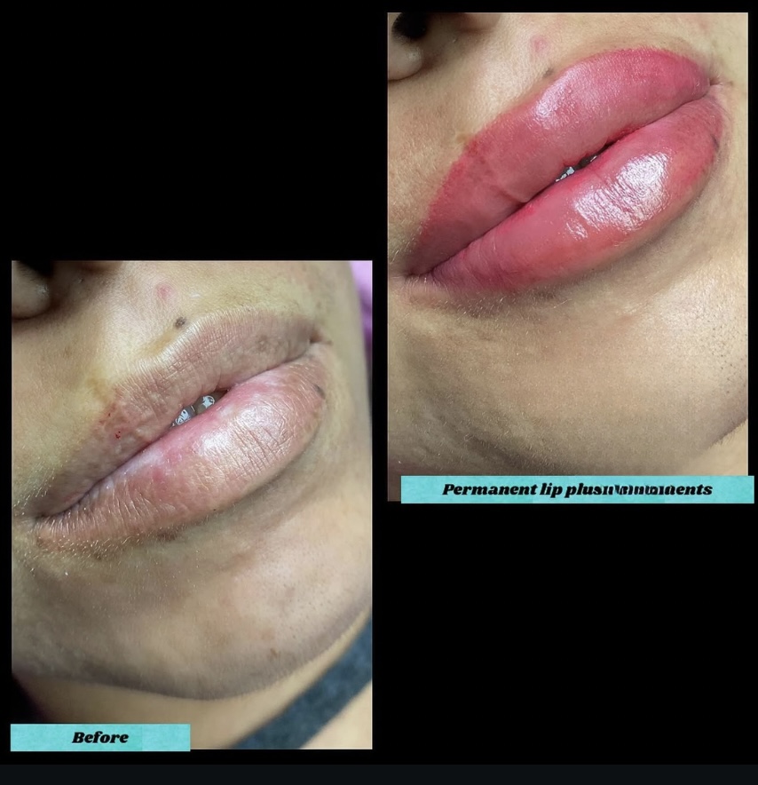 💋 Lip Blush Treatment transformation 1